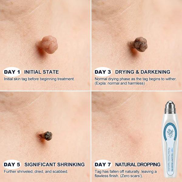 Official Store🎁7-𝐷𝑎𝑦 𝗧𝐚𝐠 & 𝗦𝗽𝐨𝐭 𝐄𝐫𝒂𝒔𝒆𝒓(Zero Pain, Zero 𝐒𝐜𝐚𝒓𝒔 Rollerball)