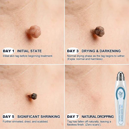 Official Store🎁7-𝐷𝑎𝑦 𝗧𝐚𝐠 & 𝗦𝗽𝐨𝐭 𝐄𝐫𝒂𝒔𝒆𝒓(Zero Pain, Zero 𝐒𝐜𝐚𝒓𝒔 Rollerball)