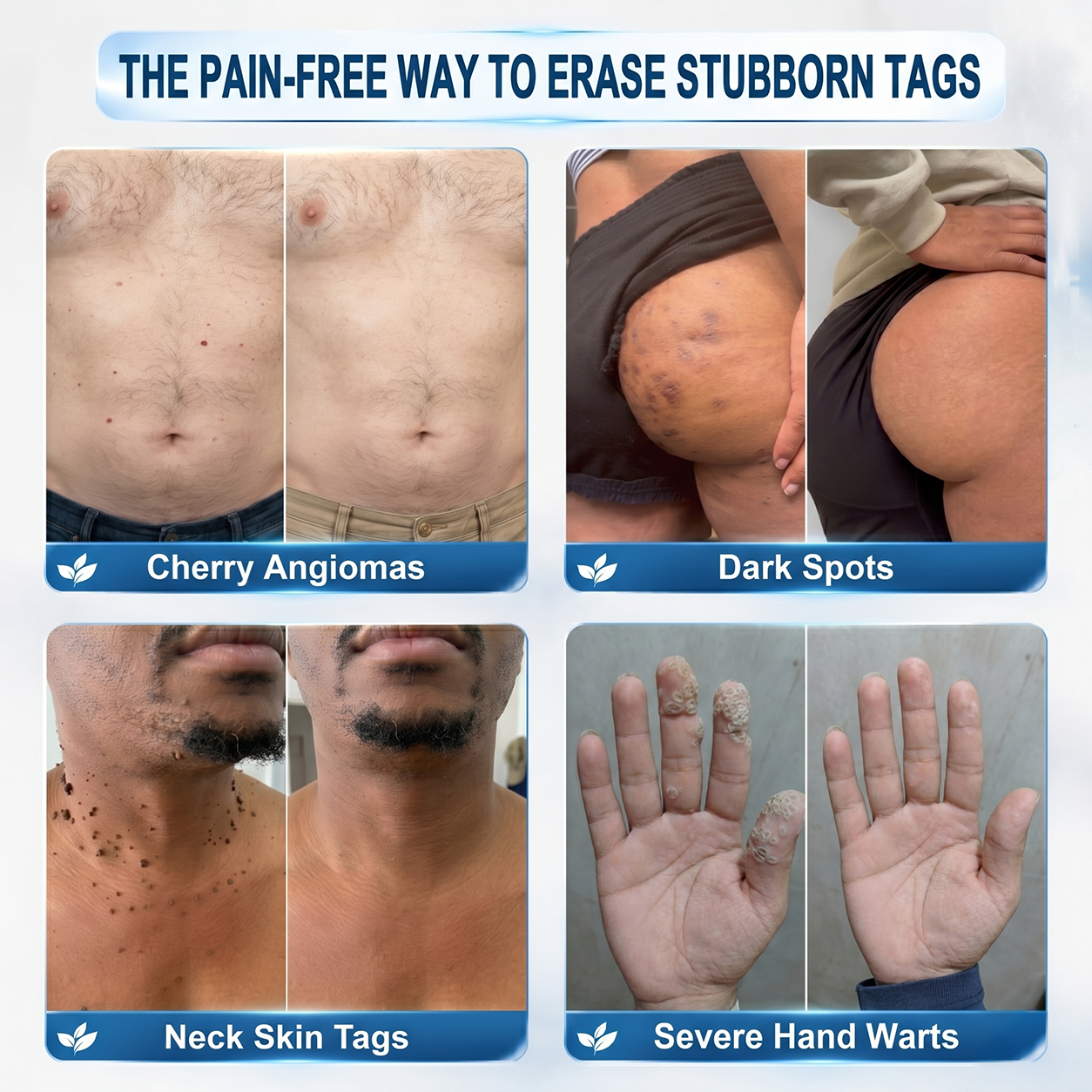 Official Store🎁7-𝐷𝑎𝑦 𝗧𝐚𝐠 & 𝗦𝗽𝐨𝐭 𝐄𝐫𝒂𝒔𝒆𝒓(Zero Pain, Zero 𝐒𝐜𝐚𝒓𝒔 Rollerball)