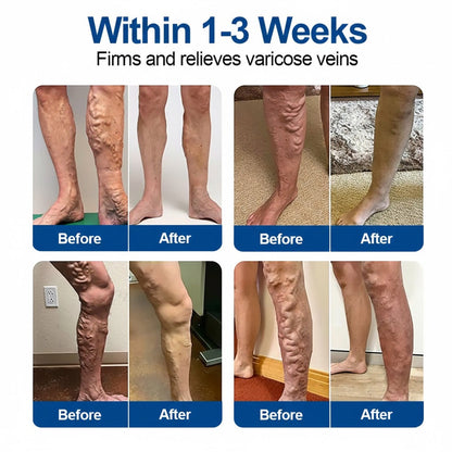 🇺🇸👨‍⚕️🔥COPURELY® VeinEase Microneedle Care Patch⚡Instant Relief, Long-Term Results
